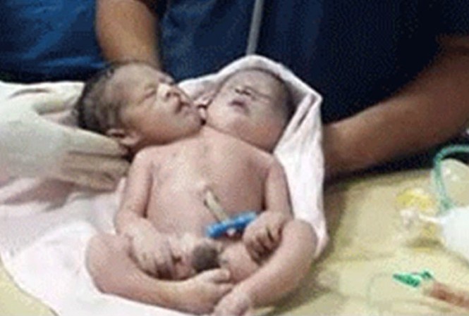 Siêu âm sinh đôi, sản phụ hốt hoảng khi đẻ ra bé trai 2 đầu 3 tay Cận cảnh đứa trẻ có 2 đầu 3 tay