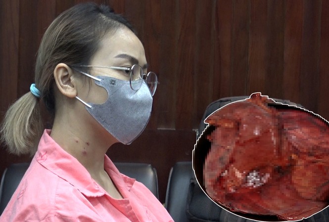 Cố nịt bụng vì sợ bị chê mập, không ngờ mang khối u tụy lớn nhất thế giới Bệnh nhân bị khối u tụy khổng lồ.