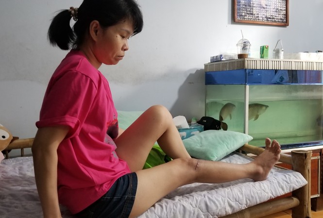 Nữ kế toán bị cháu của giám đốc siêu thị đánh gãy chân Chị Trương Thị Thu Nguyệt và thương tật ở chân