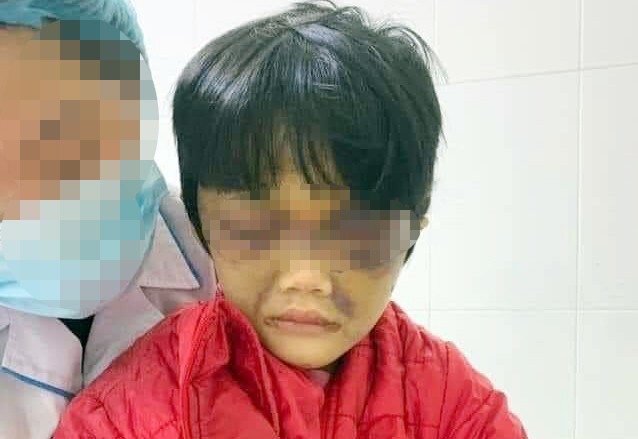 Bé gái 6 tuổi bị mẹ bạo hành ở huyện Cẩm Giàng, tỉnh Hải Dương.