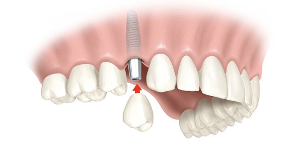Cấy ghép răng Implant ETK Active có tác dụng thế nào? Cấy ghép răng Implant ETK Active có tác dụng thế nào?