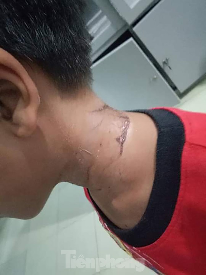 Kon Tum: Nhiều học sinh bỏng nặng vì đi bắt sâu ban miêu - ảnh 1
