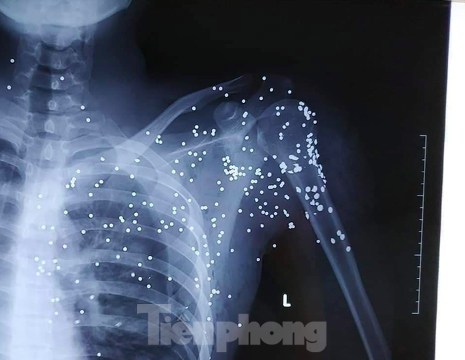 Kẻ nổ súng bắn trọng thương thanh niên 19 tuổi vì bị 'chặn đường, quây đánh' - ảnh 3
