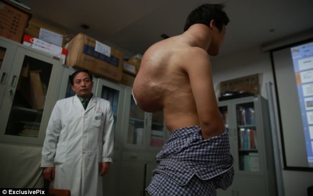 Trung Quốc: Người có khối u 10 kg tái phát sau một lần mổ ảnh 1