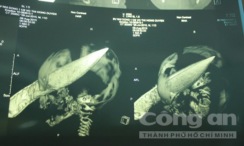 Những tình tiết rúng động vụ bé sơ sinh bị đâm xuyên sọ ảnh 2