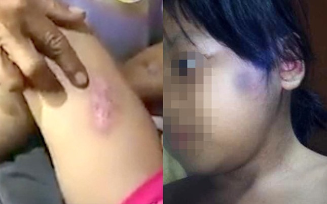 Bé gái 6 tuổi bị châm thuốc lá vào người ảnh 2
