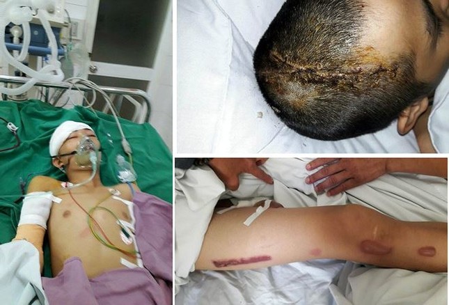 Trộm 'nhí' bị gia chủ chém thương tật 95% ảnh 2