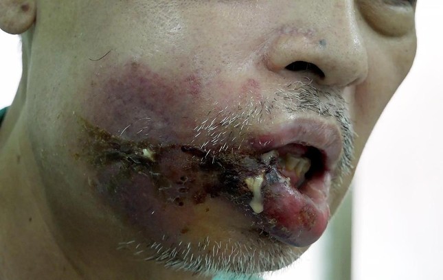 Nặn nhọt, bất ngờ phát hiện tiểu đường nặng ảnh 1