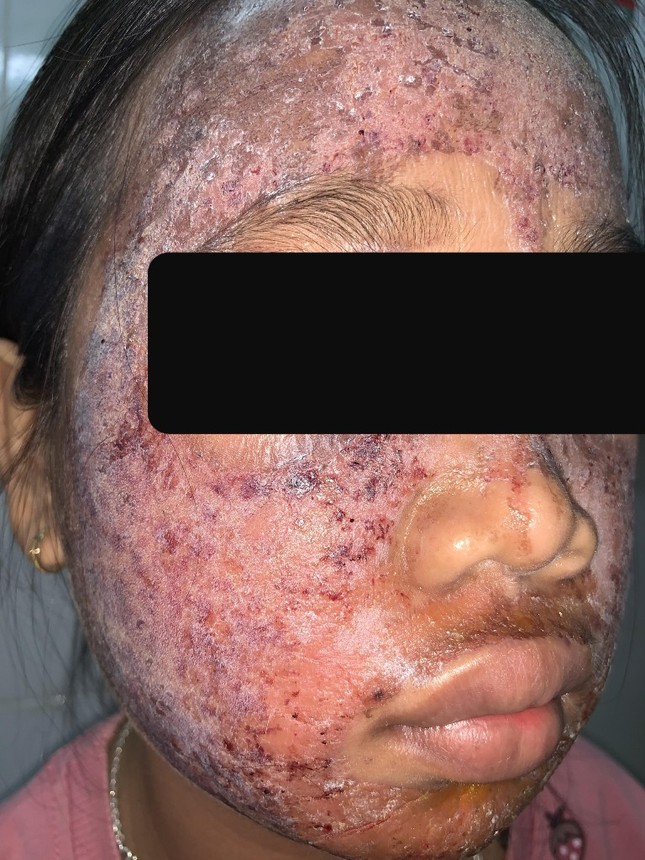 Thiếu nữ 17 tuổi hỏng mặt do dùng mỹ phẩm lột trắng da ảnh 1