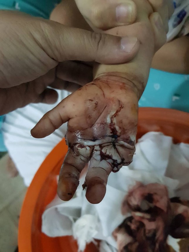 Xích xe máy cuốn đứt lìa tay bé trai 2 tuổi ảnh 2