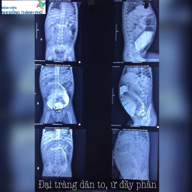 Bé trai 5 tuổi bụng phình to như bà bầu vì táo bón ảnh 2