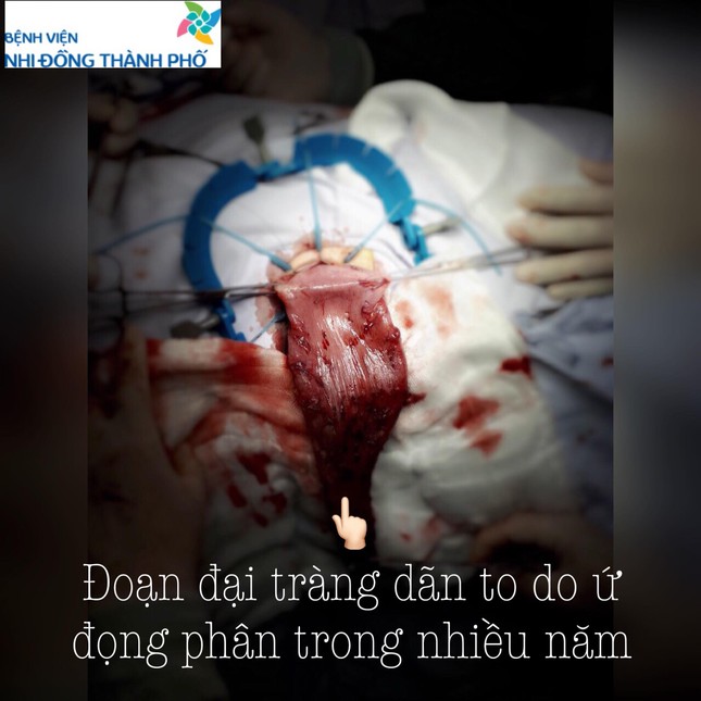 Bé trai 5 tuổi bụng phình to như bà bầu vì táo bón ảnh 1