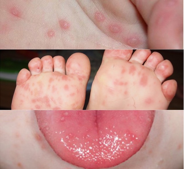 Chủng virus gây đại dịch tay chân miệng năm 2011 đã trở lại? ảnh 1