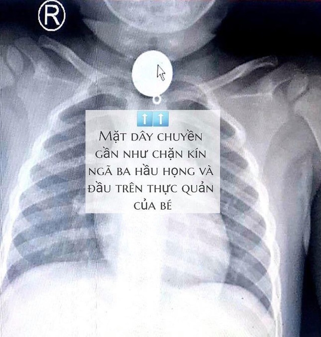 Bé trai 2 tuổi suýt chết vì nuốt chửng mặt dây chuyền ảnh 1