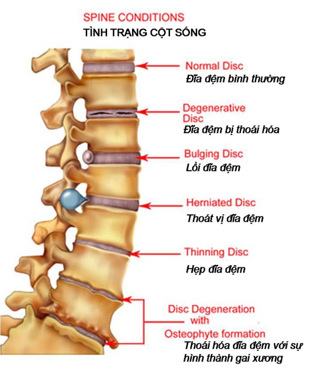 Thoái hóa cột sống - Làm thế nào để khỏi bệnh? ảnh 1