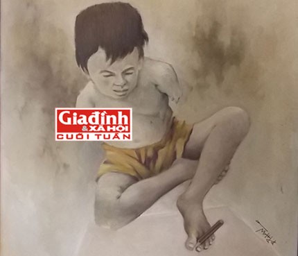 Cuộc sống trường thọ của người đàn ông có tim nằm bên phải ảnh 1