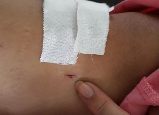 Khoan nhầm cẳng chân của bệnh nhân, đình chỉ công tác hai nhân viên y tế ảnh 1