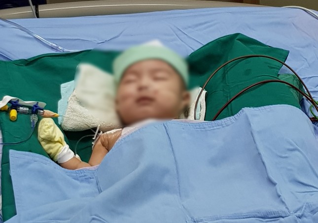 Vá lỗ thông liên thất cực lớn, cứu sống bé trai 5 tháng tuổi ảnh 1