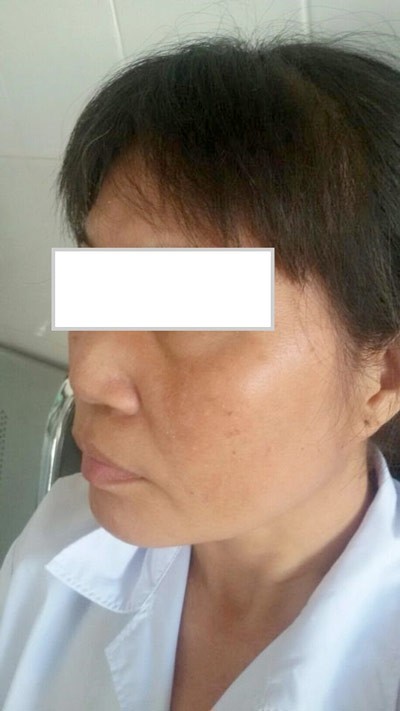 Mũi sưng, lở loét vì tiêm chất làm đẹp ảnh 1
