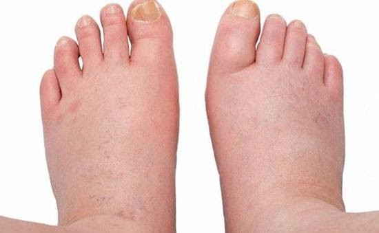 Cảnh báo dấu hiệu bệnh suy thận - Chớ xem thường kẻo hối hận không kịp ảnh 1