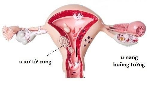 Những kiến thức cơ bản về bệnh u xơ tử cung, u nang buồng trứng ảnh 1