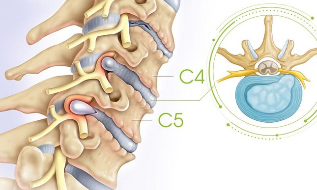 Cốt Thoái Vương - Xua tan nỗi lo thoát vị đĩa đệm cổ ảnh 1