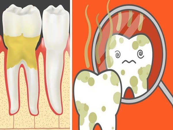Bỏ túi ngay các mẹo hay trị hôi miệng ảnh 1