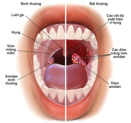 Vương Phế An - Giải pháp đột phá giảm viêm họng hạt, viêm amidan ảnh 1