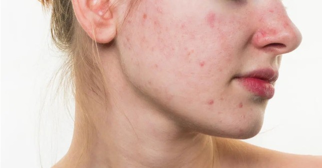 Chuyên gia chỉ cách chăm sóc da mụn như thế nào là đúng và đủ ảnh 1