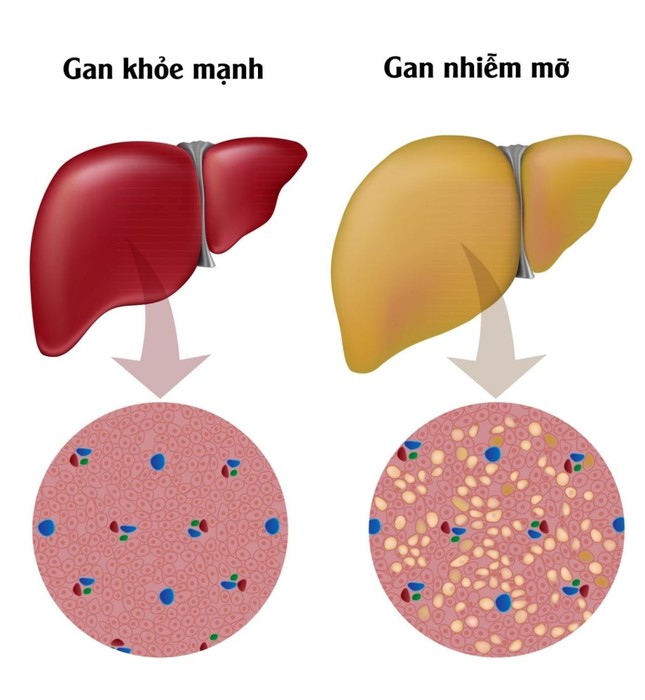 Máu nhiễm mỡ có nguy hiểm không? Cách dọn sạch mỡ máu của người Nhật ảnh 1