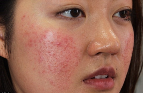 Bí quyết trị mụn cho làn da nhạy cảm ảnh 2