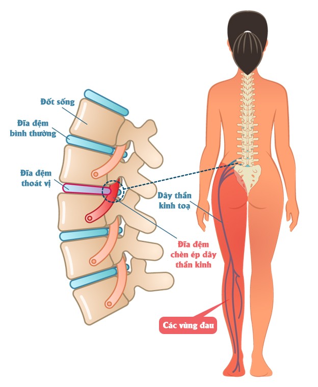 Đối phó với chứng đau lưng trong tiết trời giao mùa ảnh 2