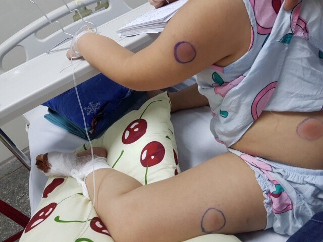 Gà mổ vào chân, bé gái bị nhiễm khuẩn “ăn thịt người” ảnh 1