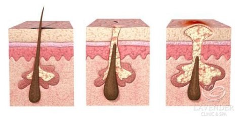 Bệnh ngoài da ở vùng kín nam giới Không thể xem thường