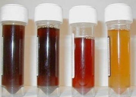 Các mức độ của máu trong nước tiểu. Các mức độ của máu trong nước tiểu.