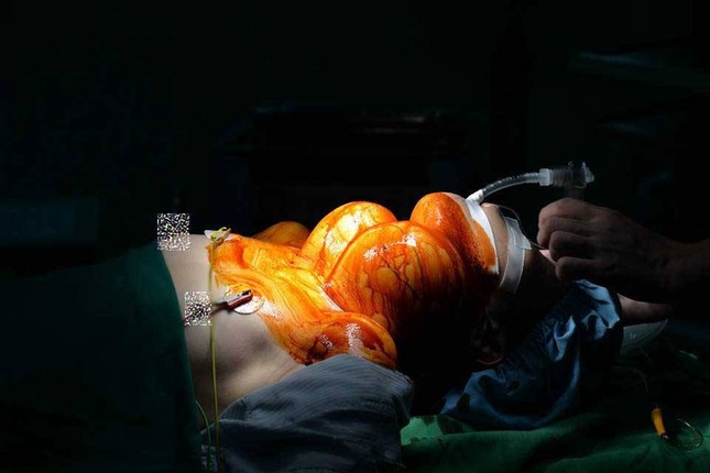 'Giải thoát' cho người phụ nữ 20 năm đeo khối u 4kg giữa cổ ảnh 1