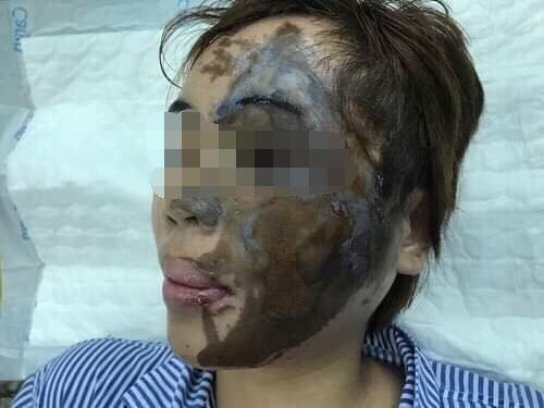 Lần đầu tiên tại Việt Nam: Tạo hình 'tươi' cho cô gái bị tạt axit ảnh 1