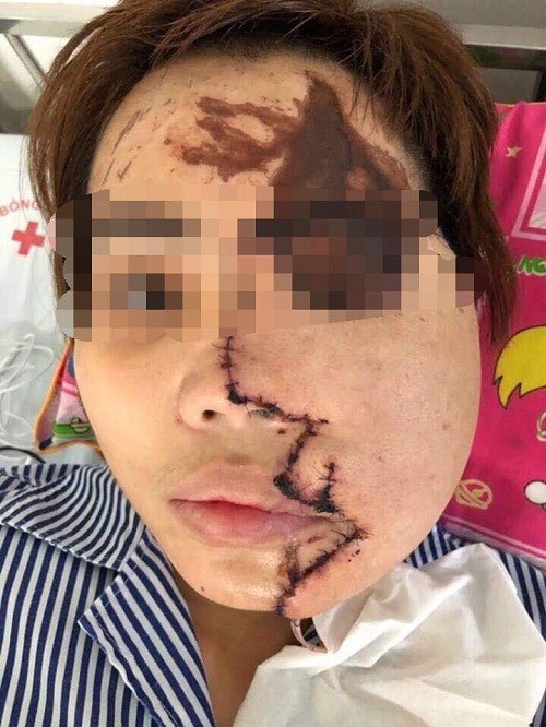 Lần đầu tiên tại Việt Nam: Tạo hình 'tươi' cho cô gái bị tạt axit ảnh 2