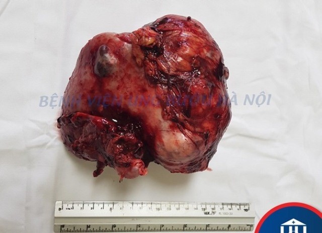 Chỉ thấy mệt, người đàn ông không ngờ thận ‘chứa’ khối ung thư hơn 2 kg ảnh 1