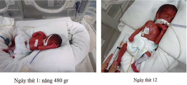 Cứu sống bé sơ sinh cực non ở Phú Thọ chỉ nặng chưa đầy nửa cân ảnh 1