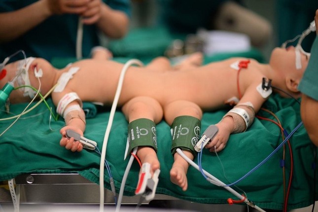 Đã tách thành công hai bé Trúc Nhi - Diệu Nhi dính nhau ảnh 1