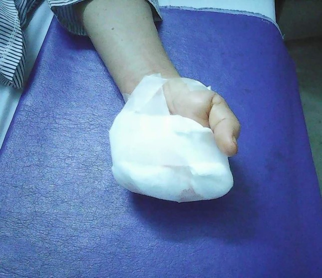 Bất cẩn khi xay thịt, một phụ nữ mất 4 ngón tay ảnh 1
