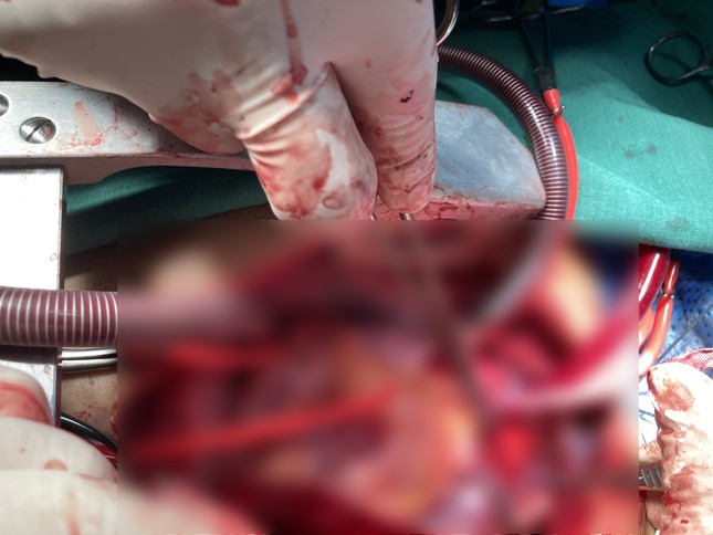 Cuộc đại phẫu 14 tiếng cứu thiếu niên 14 tuổi bị tai nạn giao thông ảnh 1