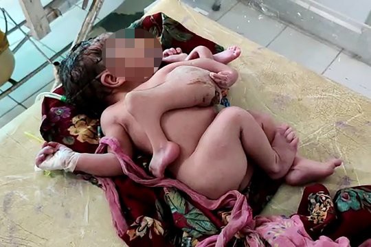 Mẹ bầu không siêu âm, sinh ra con có 3 tay 4 chân ở Ấn Độ ảnh 1