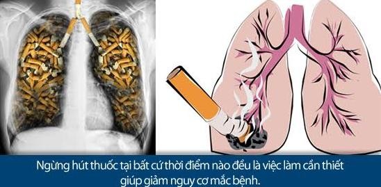 Ung thư phổi: Nguy hiểm cận kề nhưng vẫn có thể sống khoẻ ảnh 1