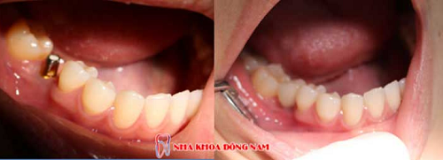 Trồng răng cấm giá bao nhiêu là chuẩn nhất? ảnh 1