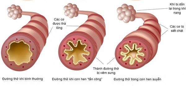 Cách chặn đứng hen suyễn, 'kẻ thù' trong mùa lạnh ảnh 1