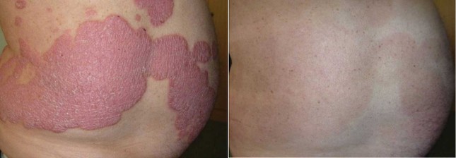 Tinh dầu thực vật giúp phục hồi tế bào bệnh vẩy nến ảnh 1
