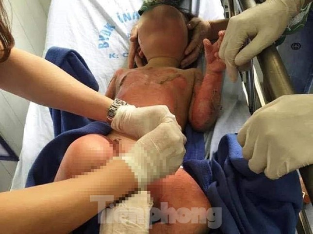 Tình tiết mới vụ 3 cháu bé mầm non bị bỏng khi học kỹ năng ảnh 2