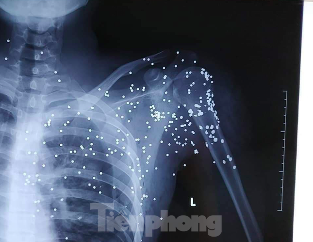 Kẻ nổ súng bắn trọng thương thanh niên 19 tuổi vì bị 'chặn đường, quây đánh' ảnh 3
